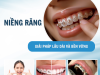NIỀNG RĂNG BỀN VỮNG