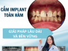 Cấy Ghép IMPLANT