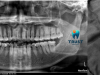 Nhổ răng khôn an toàn - dứt điểm tại T.R.U.S.T Dental