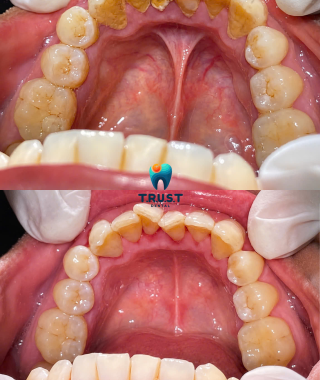 Hình trước, sau cạo vôi