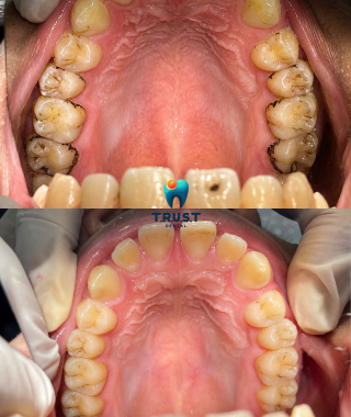 Hình trước, sau cạo vôi