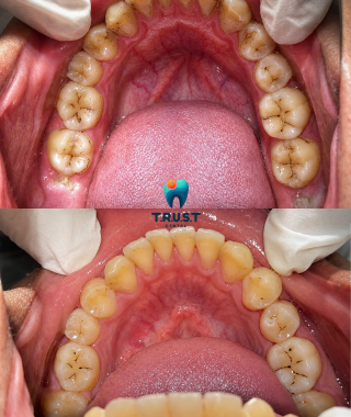 Hình trước, sau cạo vôi