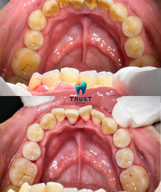 Hình trước, sau cạo vôi