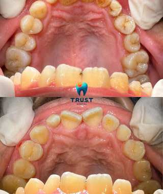 Hình trước, sau cạo vôi