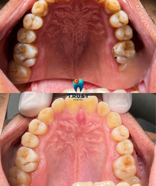 Hình trước, sau cạo vôi