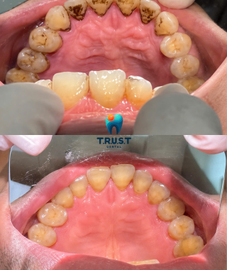 Hình trước, sau cạo vôi
