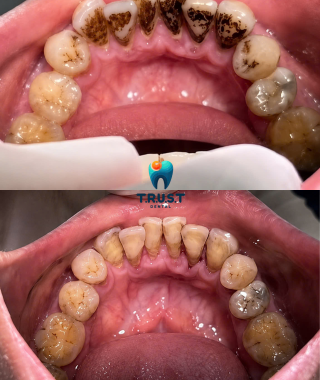 Hình trước, sau cạo vôi