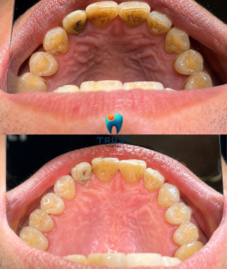 Hình trước, sau cạo vôi