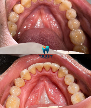 Hình trước, sau cạo vôi