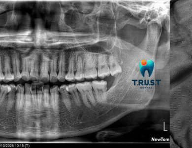 Nhổ răng khôn an toàn - dứt điểm tại T.R.U.S.T Dental