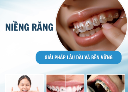 NIỀNG RĂNG BỀN VỮNG
