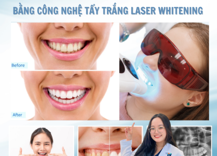 TẨY TRẮNG RĂNG