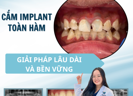 Cấy Ghép IMPLANT