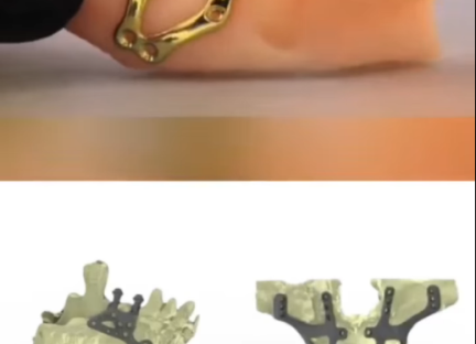 Trường hợp cấy ghép implant cho những ca thiếu hụt xương trầm trọng và phức tạp?