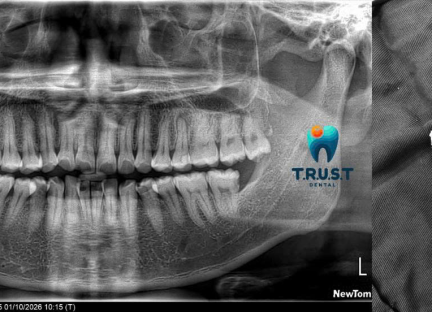 Nhổ răng khôn an toàn - dứt điểm tại T.R.U.S.T Dental