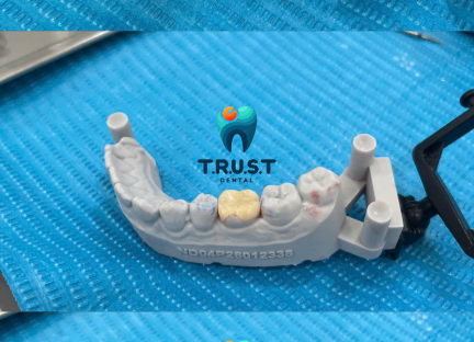 OVERLAY – GIẢI PHÁP PHỤC HỒI RĂNG MẤT MÔ LỚN
