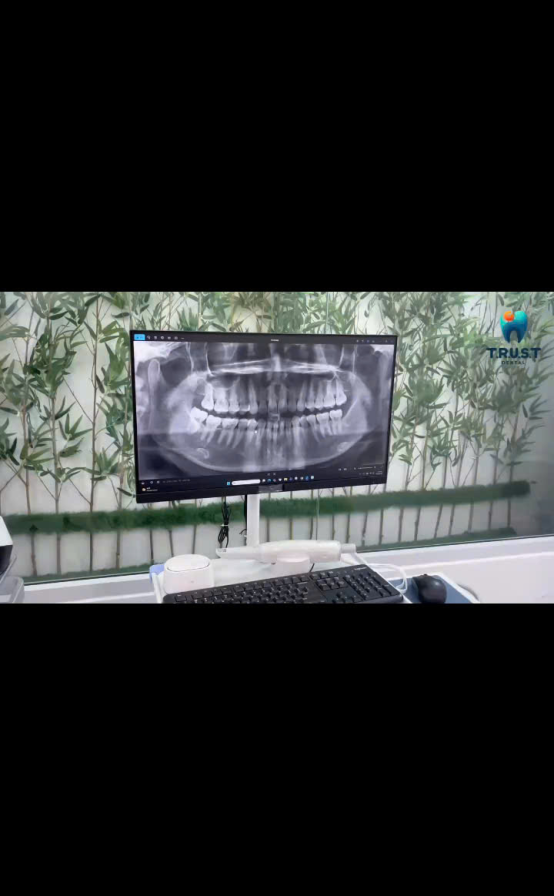Video nhổ răng khôn