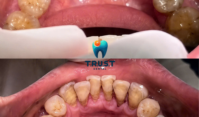 Hình trước, sau cạo vôi