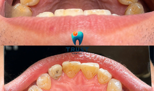 Hình trước, sau cạo vôi