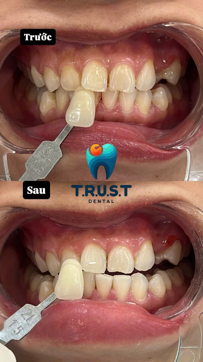 tẩy răng trắng