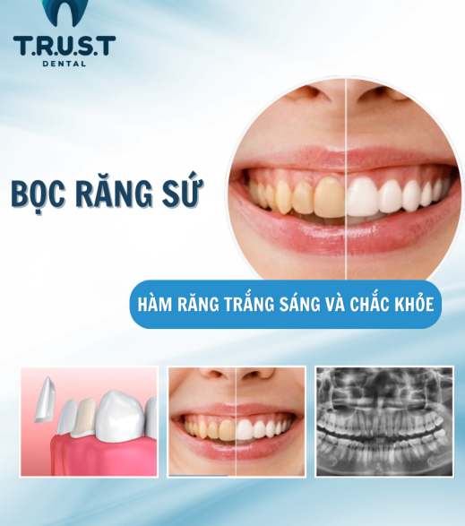 BỌC RĂNG SỨ