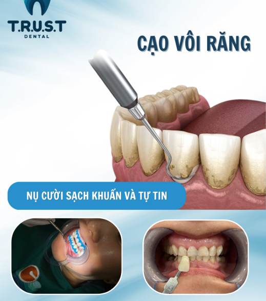 CẠO VÔI RĂNG