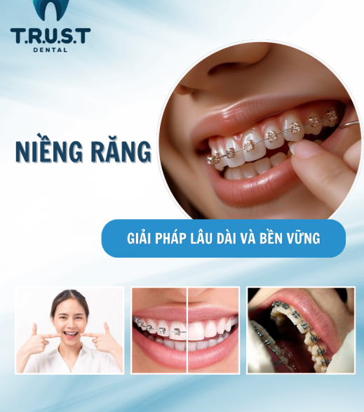 NIỀNG RĂNG BỀN VỮNG