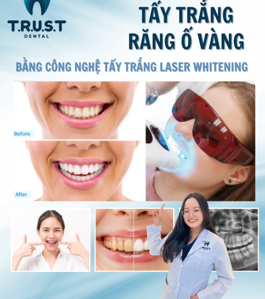 TẨY TRẮNG RĂNG