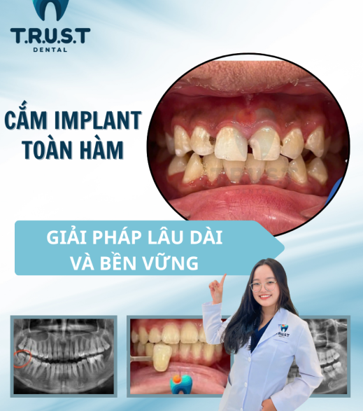 Cấy Ghép IMPLANT